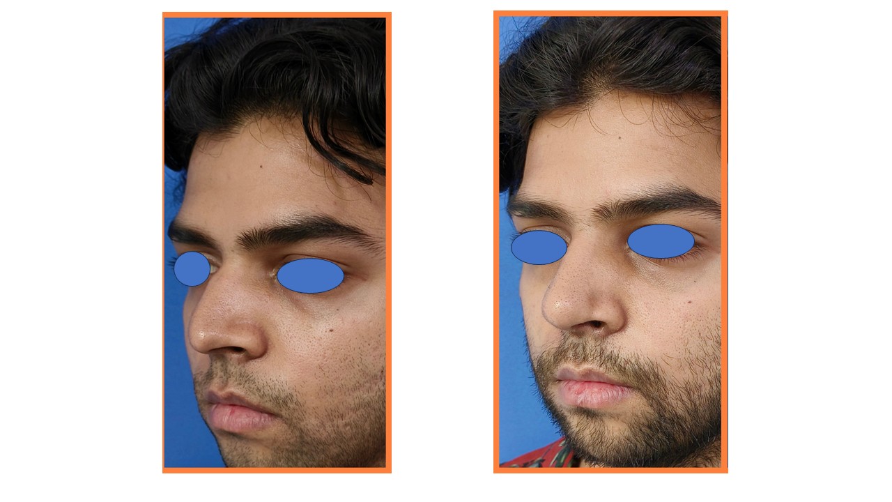 Rhinoplasty Photo 13